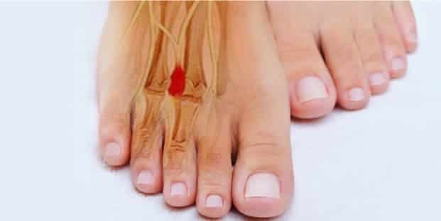neuroma di morton
