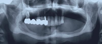 Radiografia - Mascella