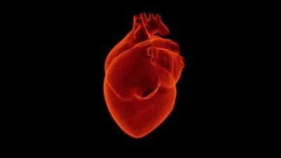 Infarto del miocardio