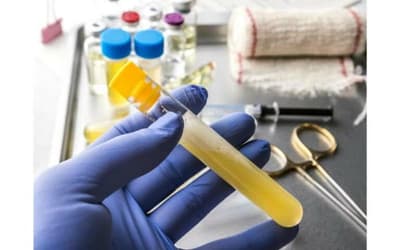 Cellule pavimentose nelle urine