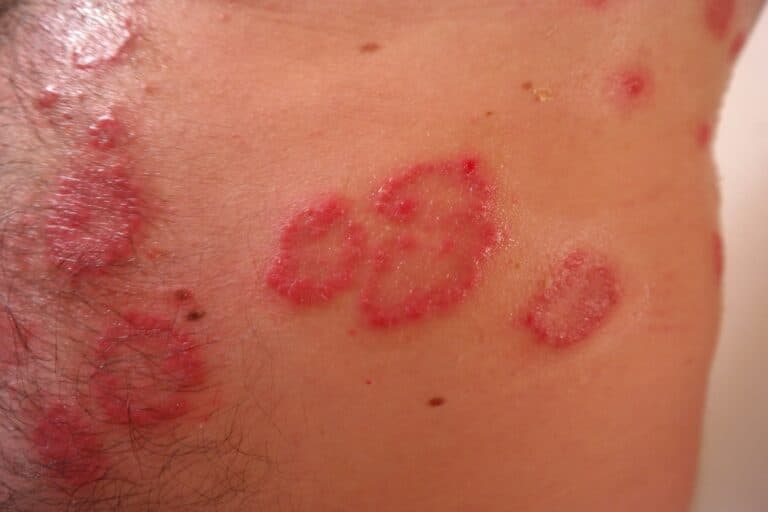 dermatiti atopiche