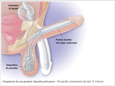 Impianto-Protesi-Peniena