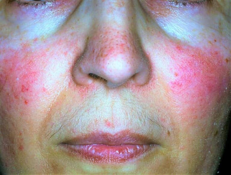 couperose rosacea