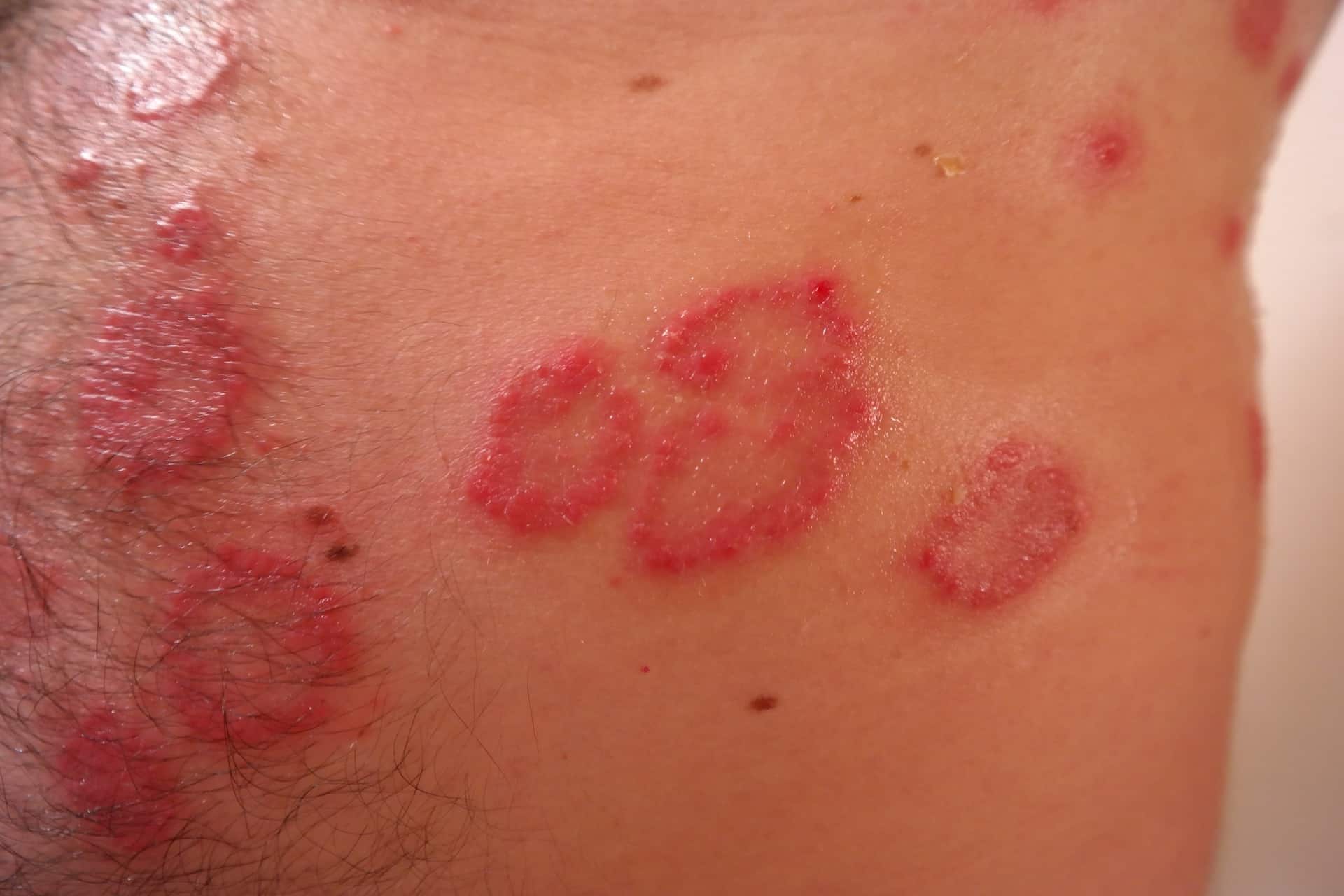 dermatite psoriasi
