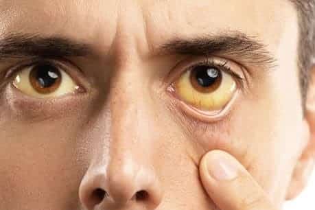 sindrome di gilbert