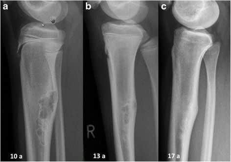 Lastra di un fibroma non ossificante tibiale