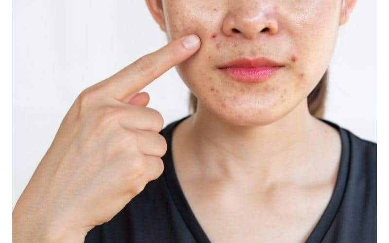 acne comedonica cause