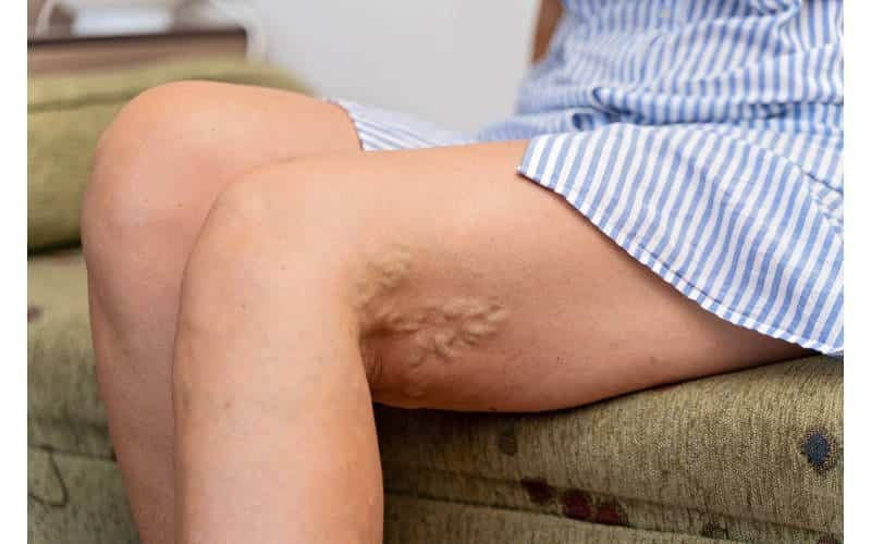 scleroterapia capillari e vene varicose